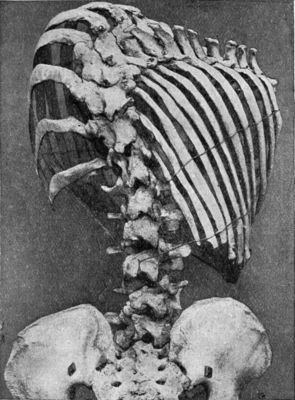 Fig. 229.—Scoliosis showing rotation of bodies of vertebræ, and widening of intercostal spaces on side of convexity.