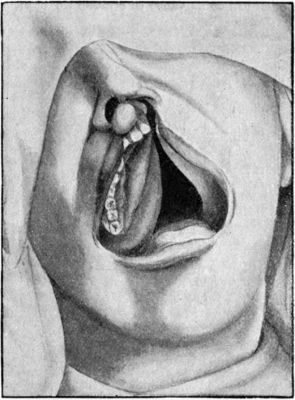 Fig. 236.—Asymmetrical Cleft Palate extending through alveolar process on left side.