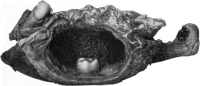 Fig. 252.—Dentigerous Cyst of Mandible containing rudimentary tooth.