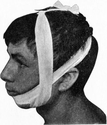 Fig. 255.—Four-tailed Bandage applied for Fracture of Mandible.