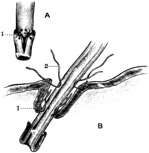 The Relation of Parts after Ricard’s Operation of Uretero-cysto-neostomy