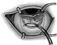 Lagrange Operation For the Production of a Cystoid Scar in Chronic Glaucoma.