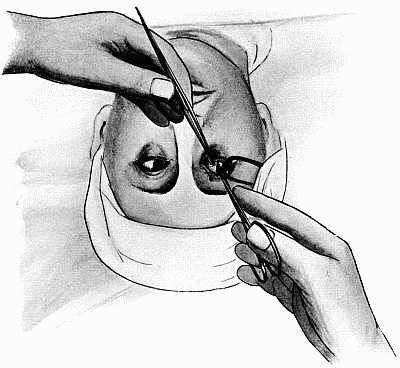 Tenotomy