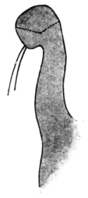 Fergus’s Operation for Slight Ectropion of the Lower Lid