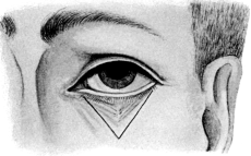 VY Operation for Ectropion of the Lower Lid