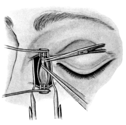 Excision of the Lachrymal Sac