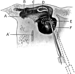 Diagrammatic Section to show Correct and Wrong Positions of Incus Hook