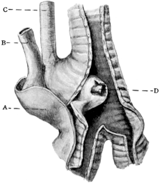 Aneurism of the Aorta perforating the Trachea