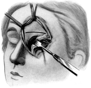 Killian’s Operation upon the Frontal Sinus