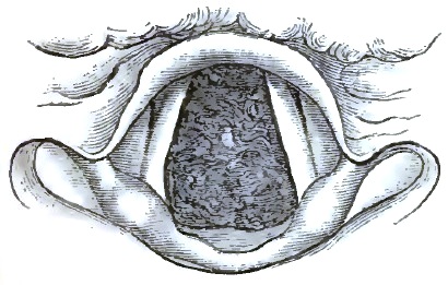 Syphilitic Ulceration of Trachea