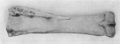 Fig. 16—Posterior view of radius (right) illustrative of effects of splint. Note the extent of exostosis.