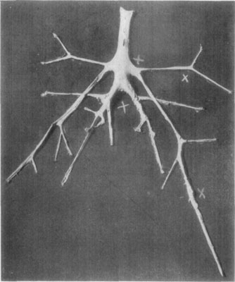 Fig. 48—Exposure of aorta and its branches, showing location of thrombi in numerous places. In this case (same as Fig. 49) Dr. L.A. and Dr. Edward Merillat found the cause of the condition to be due to sclerastomiasis.