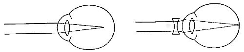 FIG. 81.—The nearsighted eye. The defect is remedied by concave glasses.