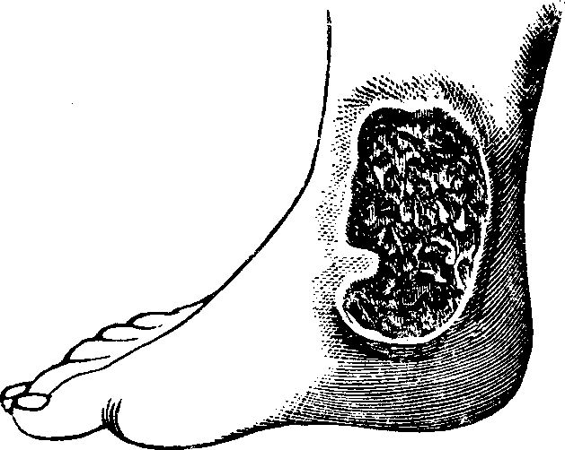 Illustration: Fig. 2. A Chronic Ulcer.