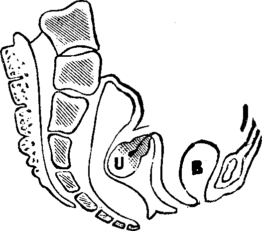 Illustration: Fig. 13. Retroversion. B, Bladder. U, Uterus (Womb).