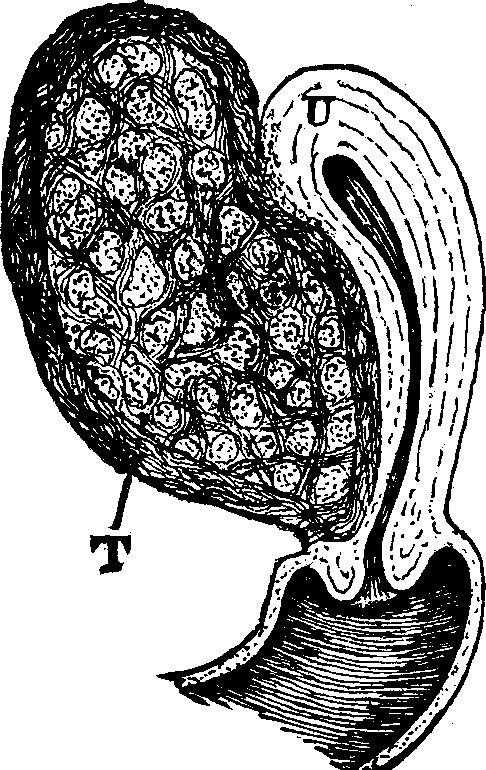 Illustration: Fig. 20. U, Uterus. T, Tumor.