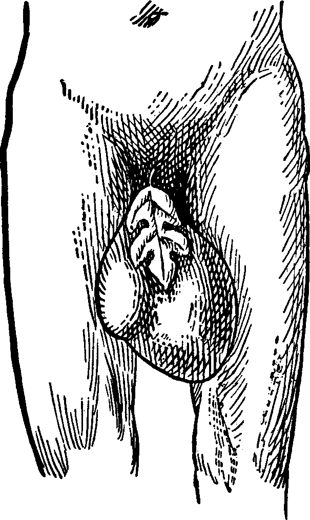 Illustration: Fig. 4. The above cut fairly illustrates a case of Double Inguinal Hernia, complicated with Hydrocele, cured at the Invalids' Hotel and Surgical Institute.