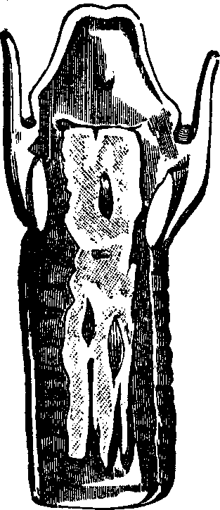 Illustration: Fig. 1. False Membrane in Croup. From a specimen in Dr. Gross' cabinet.