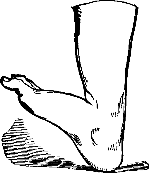 Illustration: Fig. 11. Talipes Calcaneus.