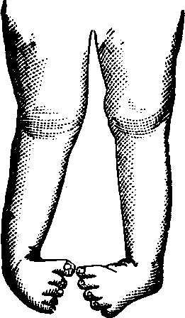 Illustration: Fig. 13. Double Club-foot.