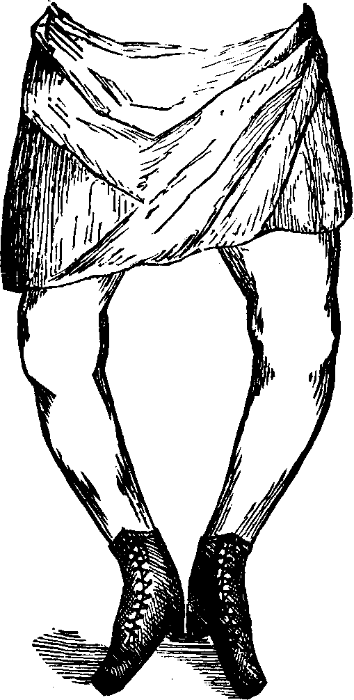 Illustration: Fig. 14. Bow-legs.