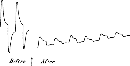 Fig. 47.—Abolition of Response at both A and B Ends by the Action of NaOH