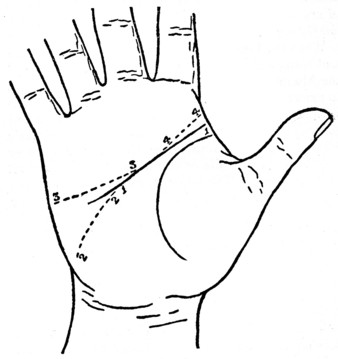 Plate III. THE LINE OF HEAD SEPARATED FROM THE LINE OF LIFE.