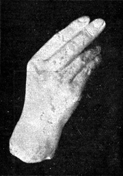 CARL ANGELI'S HAND.