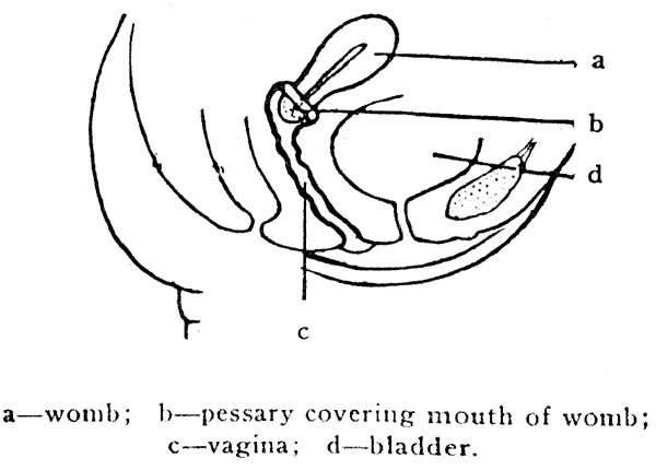 a—womb; b—pessary covering mouth of womb; c—vagina; d—bladder.