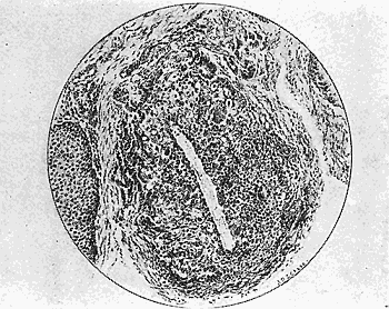 41b. Section through one of the nodules showing the caterpillar hair. De Schweinitz and Shumway.