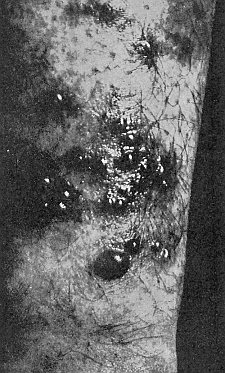 43. Effect of the harvest mites on the skin of man. Photograph by J. C. Bradley.