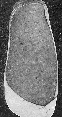 68. Melanoderma caused by the body louse. From Portfolio of Dermochromes, by permission of Rebman & Co., New York, Publishers.