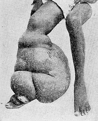 119. Elephantiasis in Man. From "New Sydenham Society's Atlas."