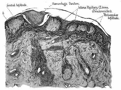 173. Fifth day mature lesion. Lower power drawing showing papillary œdema and infiltrate in the region of the puncture.