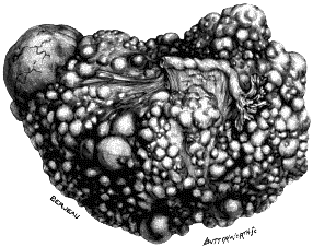 Secondary Cancer of the Ovary