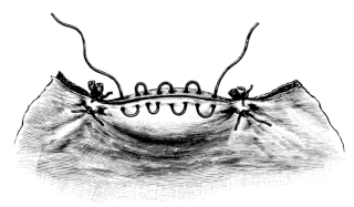 The Stump after Subtotal Hysterectomy