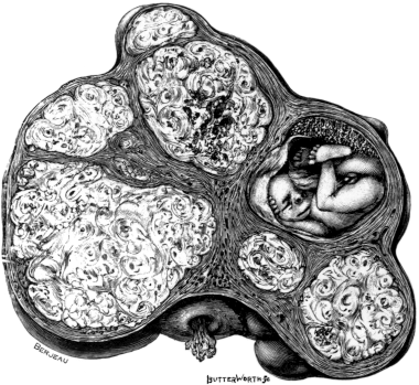 A Uterus distorted by Fibroids