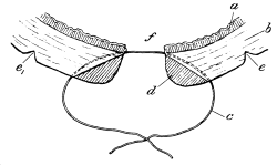 Sims’s Operation for the Repair of a Vesico-vaginal Fistula