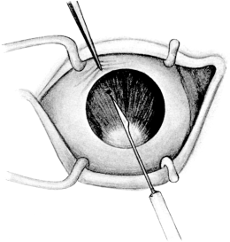 Iridotomy by Ziegler’s Method