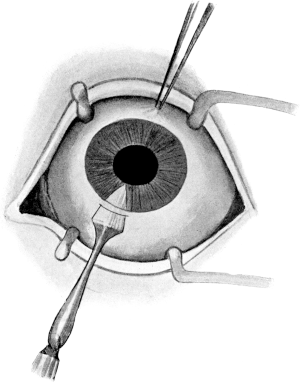 Optical Iridectomy