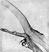 The Angle of the Anterior Chamber from a Case of Recent Glaucoma