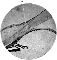 The Angle of the Chamber in a case of Chronic Glaucoma