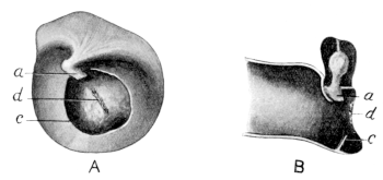 Division of Intratympanic Adhesion with Excision of Handle of Malleus