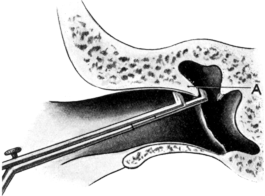 Removal of Outer Attic-wall with Forceps