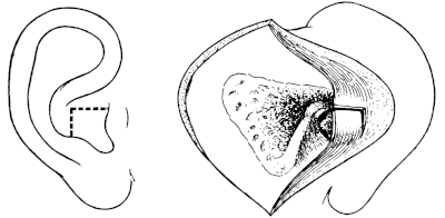 Stacke’s Post-meatal Flap