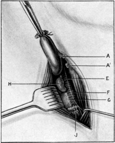 Ligature of the Internal Jugular Vein low down in the Neck