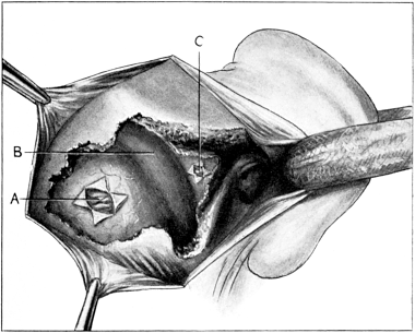 Exploration for a Cerebellar Abscess