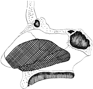 Submucous Resection of the Septum