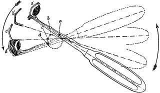 The Removal of Naso-pharyngeal Adenoids