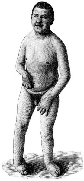 Fig. 20. Idiotismus mit zebraler Kinderlähmung.